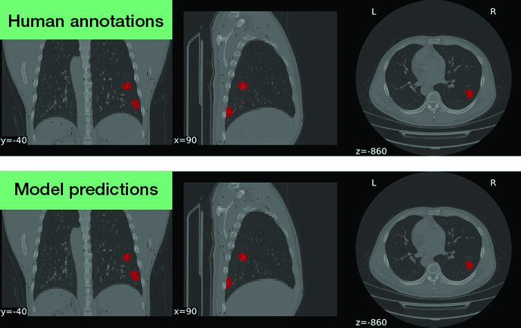 Deep learning to identify COVID-19 lesions in lung CT scans overview